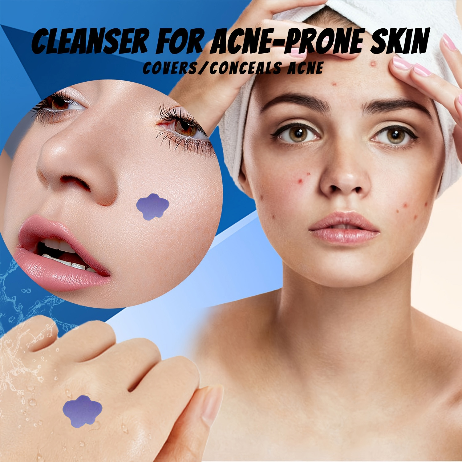 Microneedle Acne Pimple Patch  - đánh giá và giá Skincare Acne