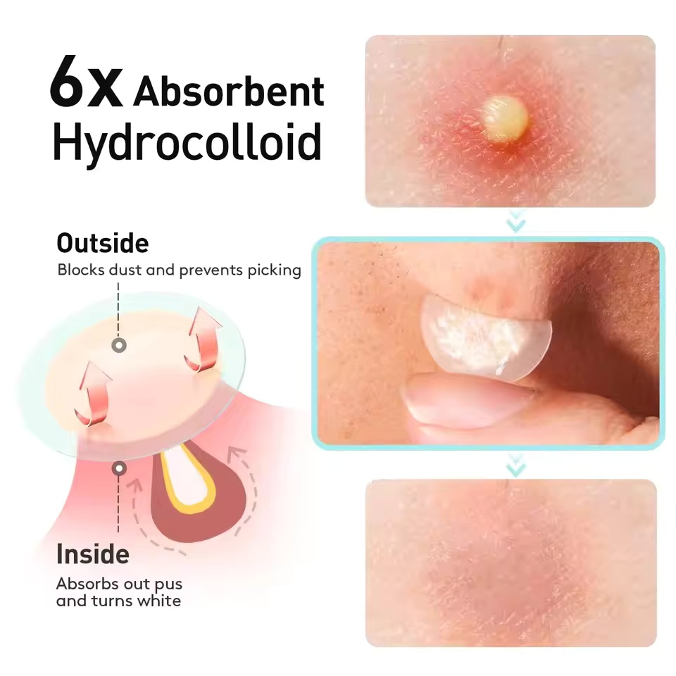 443pcs water-based gel acne pa - đánh giá và giá Skincare Acne